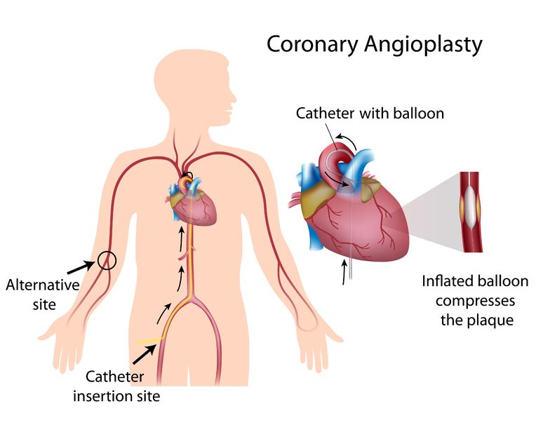 Coronary Angioplasty | Best Coronary Angioplasty done in Indore | Top Cardiologist in Indore