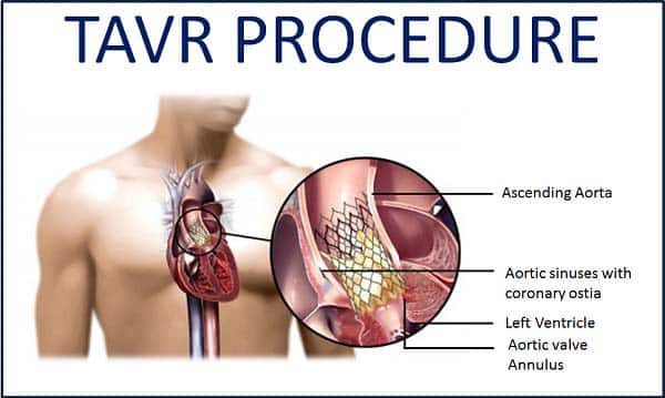 TAVR Procedure in Indore | Best Heart Doctor in Indore