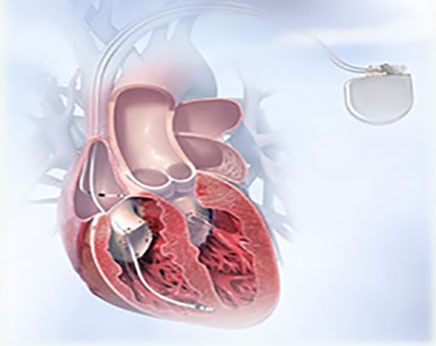 Automatic Implantable Cardioverter | ACID | Best Cardiologist in Indore