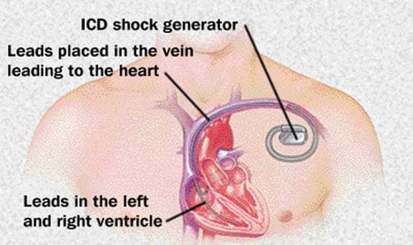 ACID | Cardiologist in MP
