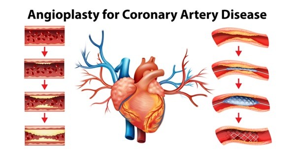 Best Angioplasty | Coronary Artery Disease in Indore