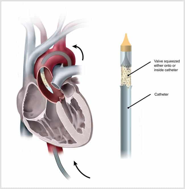 catheter valve in Indore | Best Cardiologist in Indore