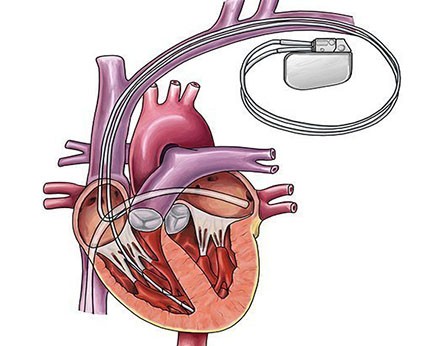 Combo Device Implantation | Heart Disease Dr in Indore | Best Heart Specialist dr in Indore