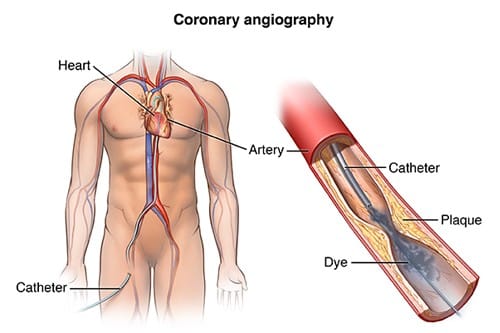 Best Angiography in Indore | Top Cardiologist