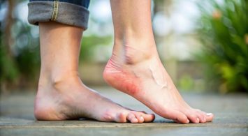 Are Swollen Feet a Sign of Heart Failure?