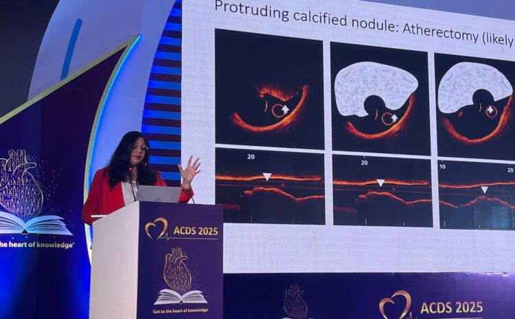 Dr. Sarita Rao - Best Cardiologist shared her views on Calcific Nodule at ACDS2025 help at Goa
