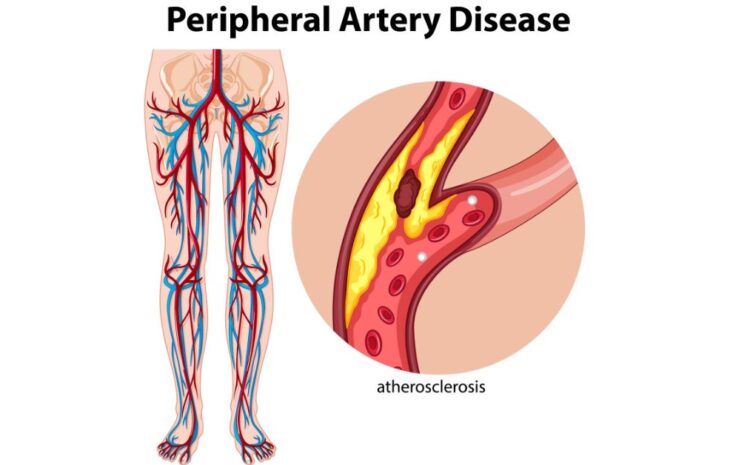 Peripheral Laser Atherectomy in indore