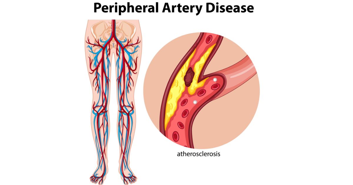 Peripheral Laser Atherectomy in indore