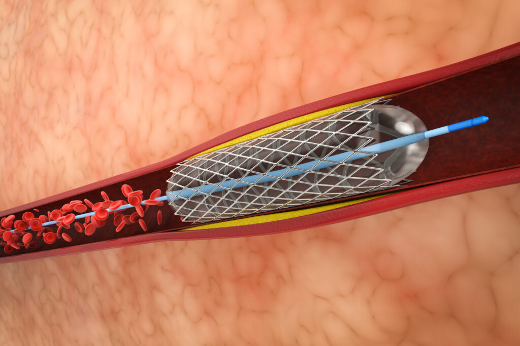 Laser Atherectomy