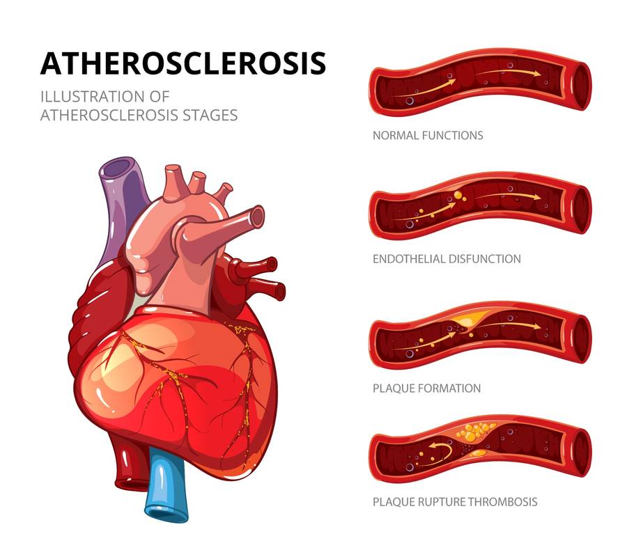 Atherosclerosis_