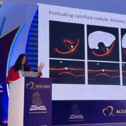 Dr. Sarita Rao - Best Cardiologist shared her views on Calcific Nodule at ACDS2025 help at Goa